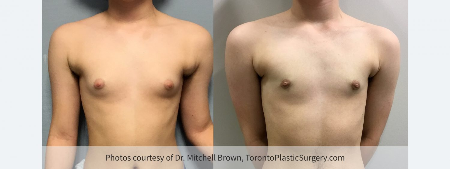 Transmale, Keyhole Mastectomy, Before and 6 Months After