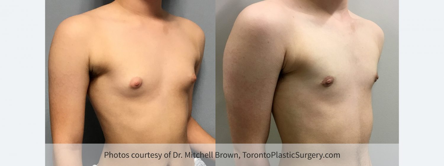 Transmale, Keyhole Mastectomy, Before and 6 Months After