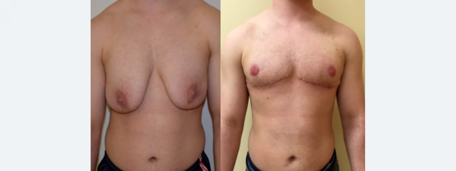 Transmale, Double Incision Free Nipple Graft, Before and 6 Months