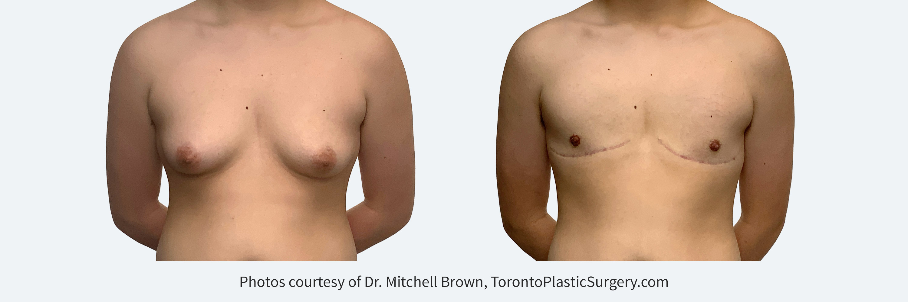 Transmale, double incision free nipple graft. Before and After 6 months. 