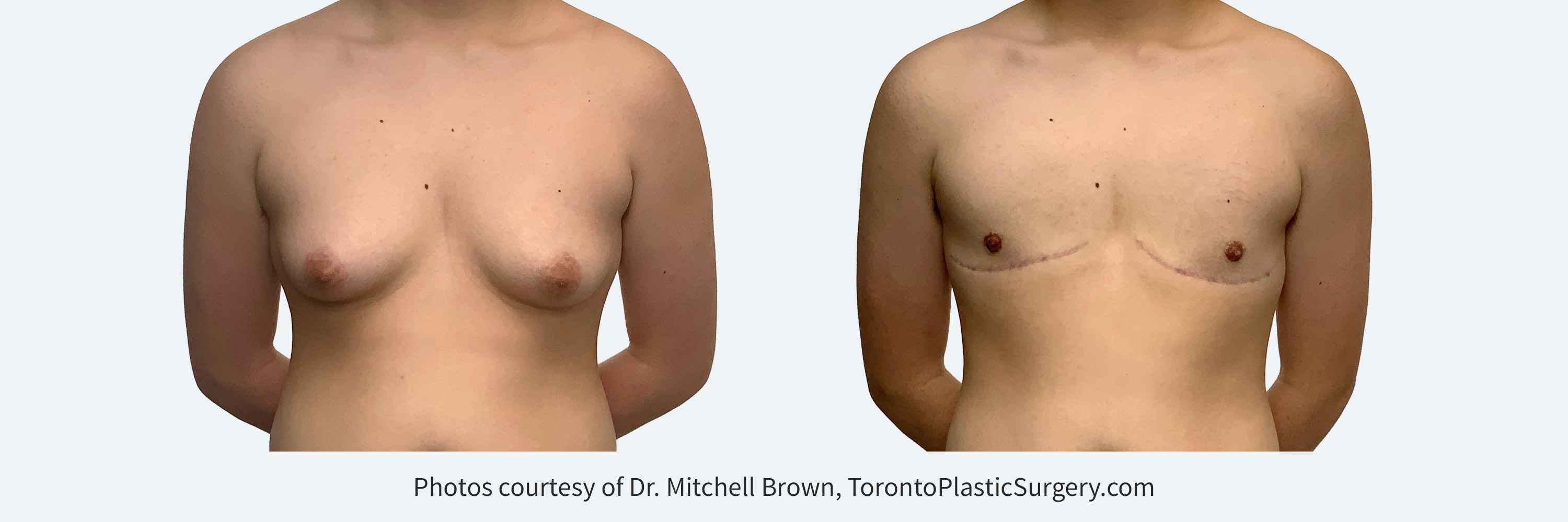 Transmale, double incision free nipple graft. Before and After 6 months.