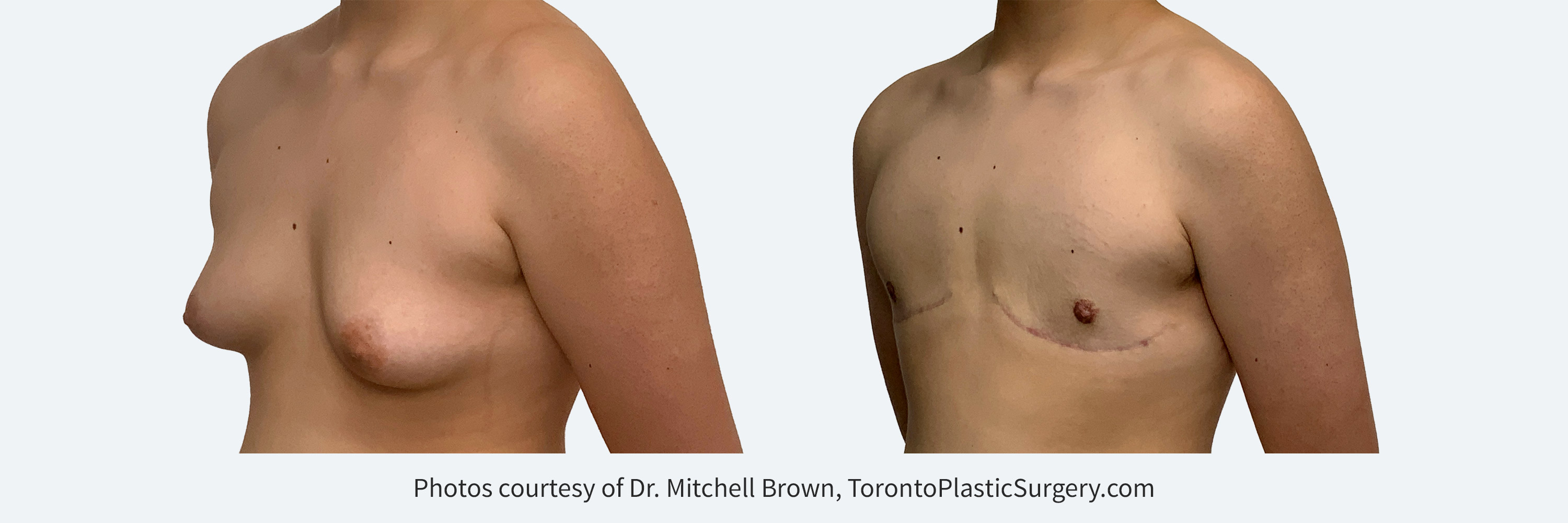 Transmale, double incision free nipple graft. Before and After 6 months. 