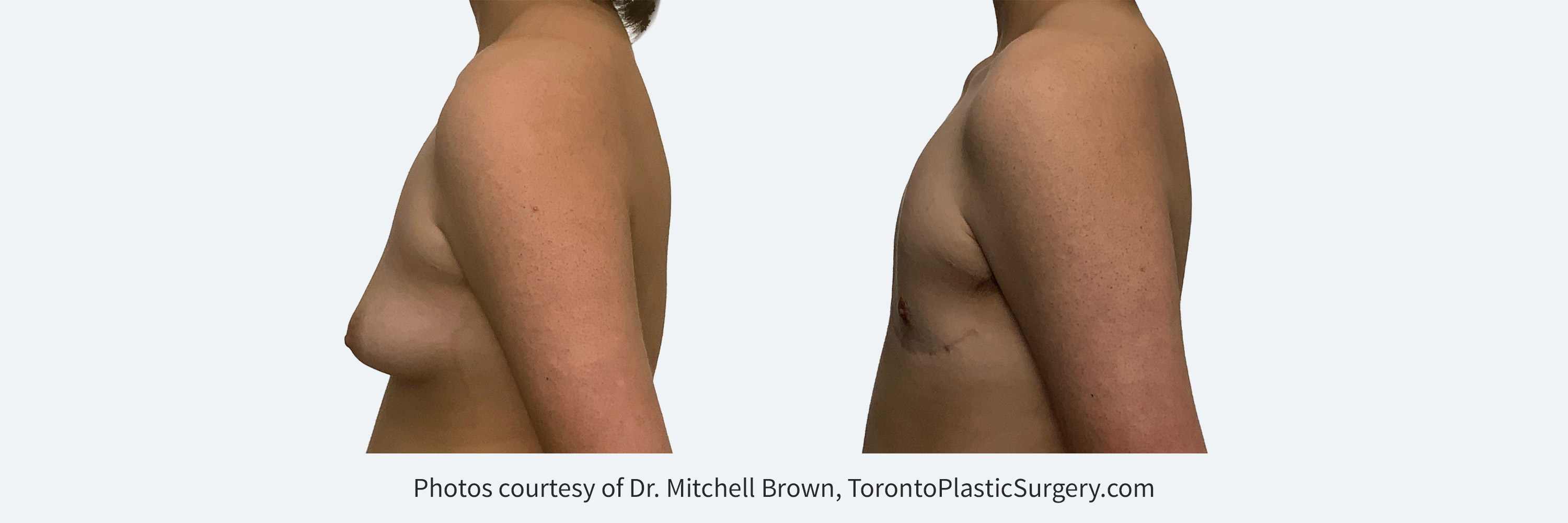 Transmale, double incision free nipple graft. Before and After 6 months. 