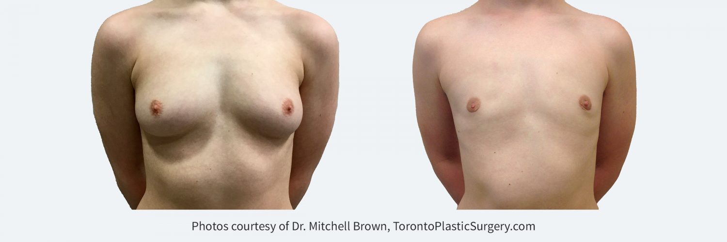 Transmale, Keyhole Mastectomy, Before and 4 months after