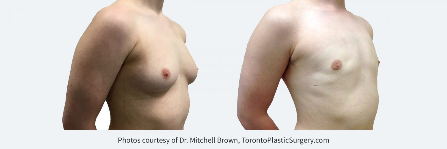 Transmale, Keyhole Mastectomy, Before and 4 months after