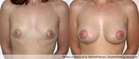Tuberous Breast, Areola Reduction with Insertion of a 295gm Shaped Gel Implant, Before and After 6 Weeks