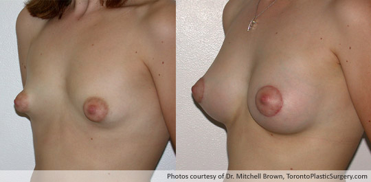 Tuberous Breast, Areola Reduction with Insertion of a 295gm Shaped Gel Implant, Before and After 6 Weeks