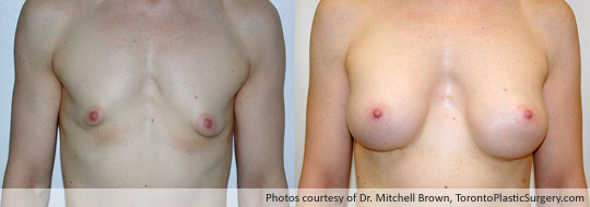 Tuberous Breast Surgery with Insertion of a 320gm Shaped Gel Implant, Before and After 4 Years