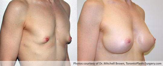 Tuberous Breast Surgery with Insertion of a 320gm Shaped Gel Implant, Before and After 4 Years