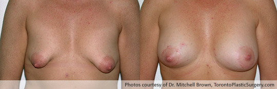 Tuberous Breast, Areola Lift and Insertion of a 375gm Shaped Gel Implant, Before and After 6 Months
