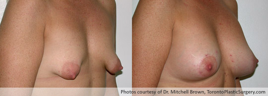 Tuberous Breast, Areola Lift and Insertion of a 375gm Shaped Gel Implant, Before and After 6 Months