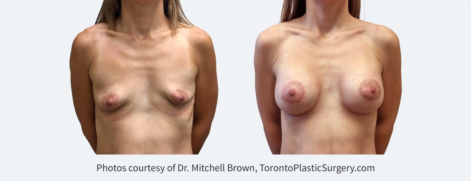 Tuberous breast treated with 295cc cohesive gel implant under the muscle along with lift and reduction of the areola. Before and 4 years after surgery.