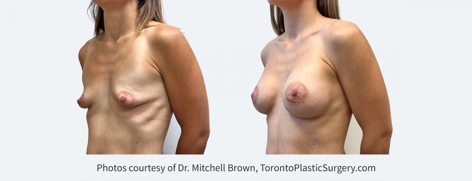 Tuberous breast treated with 295cc cohesive gel implant under the muscle along with lift and reduction of the areola. Before and 4 years after surgery.