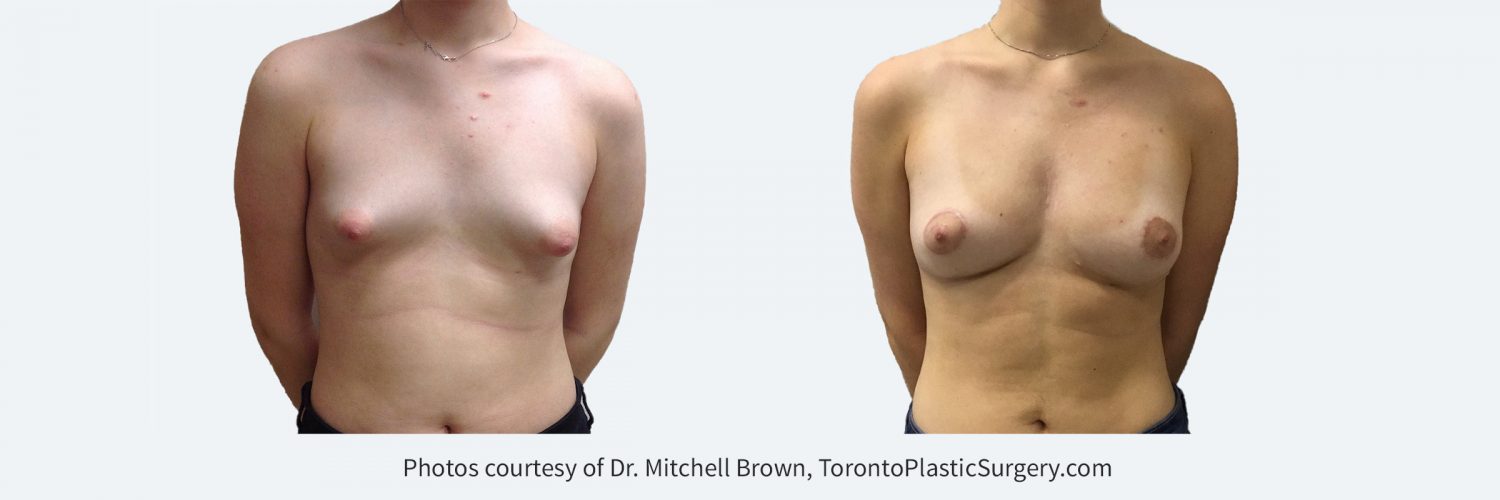 Woman with congenital tuberous breasts. Treated with two sessions of fat grafting and a lift and reduction of the areola. Before and After.