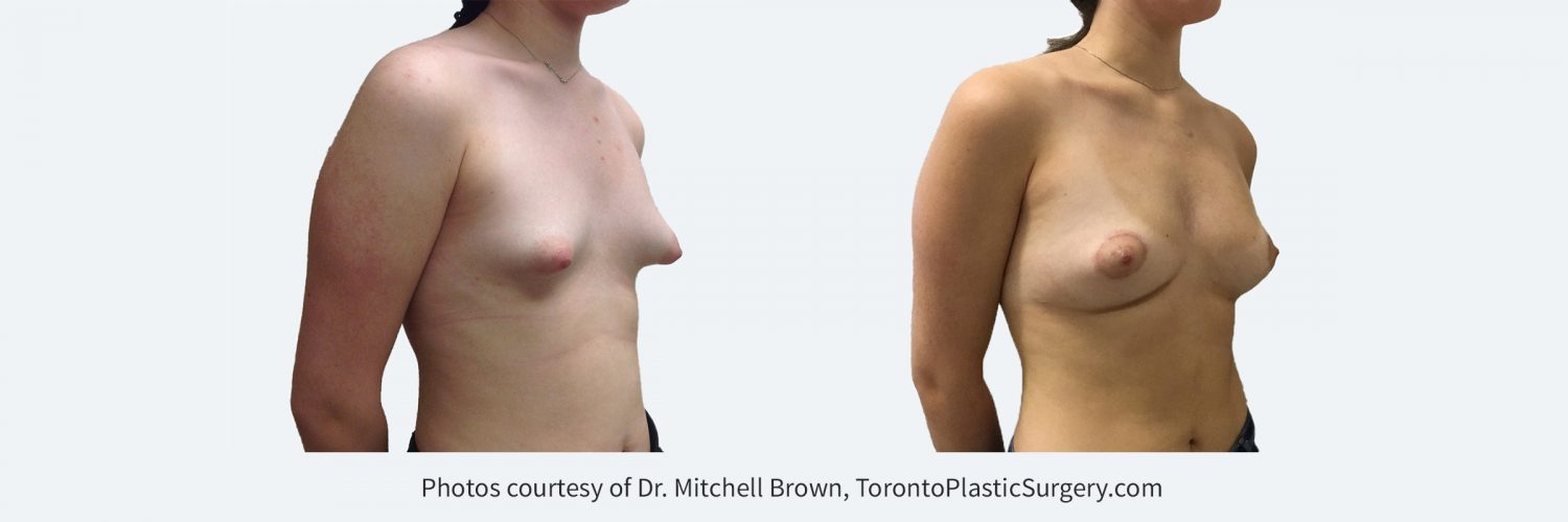 Woman with congenital tuberous breasts. Treated with two sessions of fat grafting and a lift and reduction of the areola. Before and After.