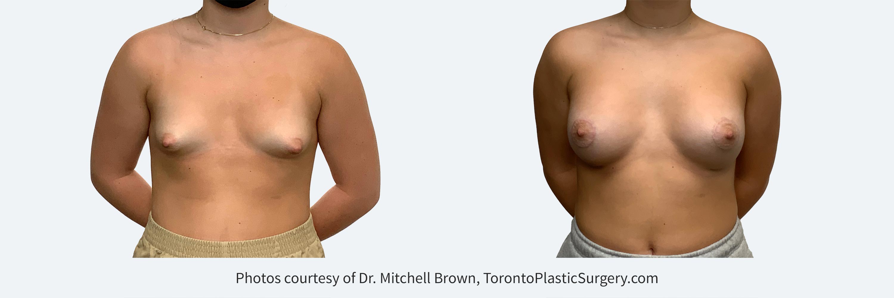 18Y with tuberous breasts treated with 275cc implants and an areola lift. Before and After 6 months.
