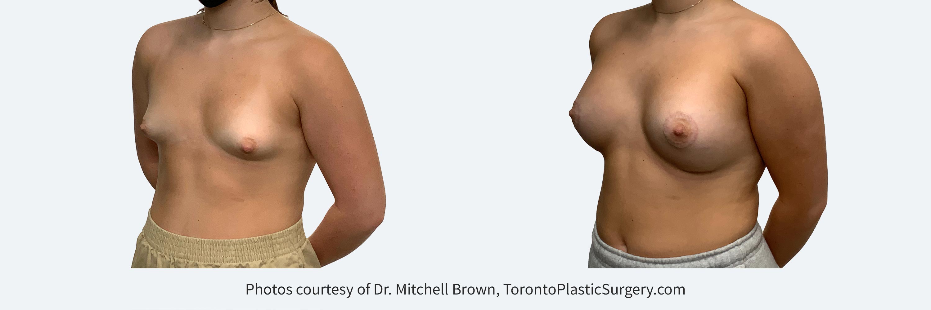 18Y with tuberous breasts treated with 275cc implants and an areola lift. Before and After 6 months.