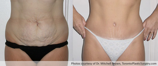 Case 1: Tummy Tuck and Liposuction of Hips, Before and After 6 Months