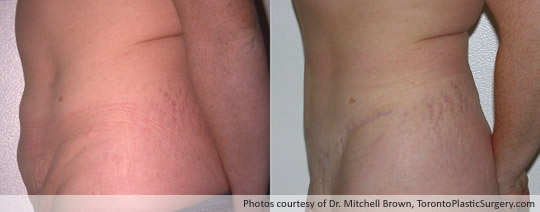 Case 2: Tummy Tuck and Revision of Caesarian Scar, Before and After 18 Months