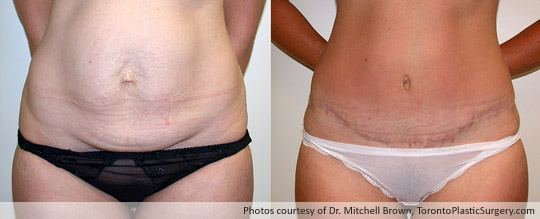 Case 3: Tummy Tuck and Liposuction of Hips, Before After 6 Months