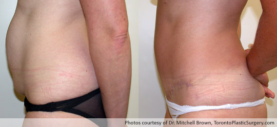 Case 3: Tummy Tuck and Liposuction of Hips, Before After 6 Months