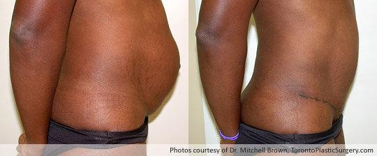 Case 4: Tummy Tuck and Muscle Repair, Before and After 6 Months