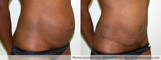 Case 4: Tummy Tuck and Muscle Repair, Before and After 6 Months