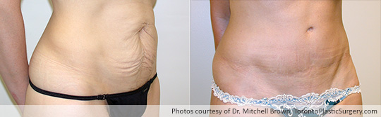 Case 5: Tummy Tuck, Before and After 7 Years