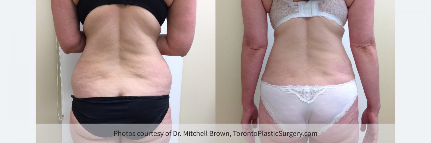 Case 6: Before and 6 months after tummy tuck with liposuction of the waist and hips