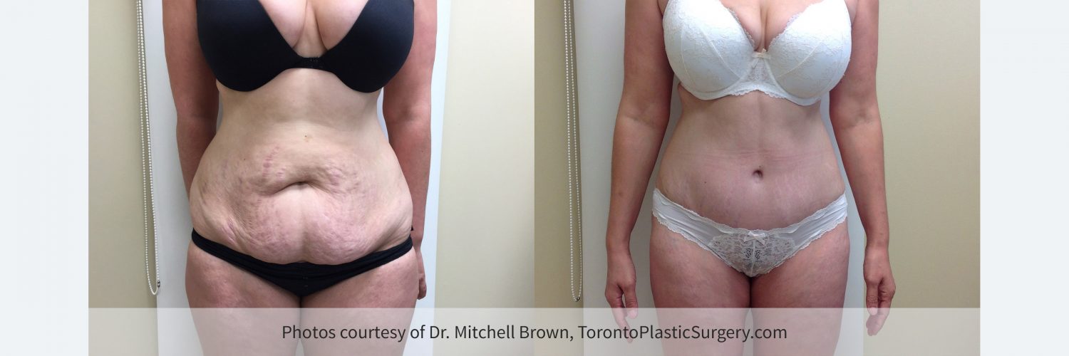 Case 6: Before and 6 months after tummy tuck with liposuction of the waist and hips