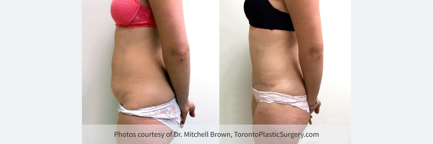 Case 7: Tummy Tuck, Before and 6 Months After