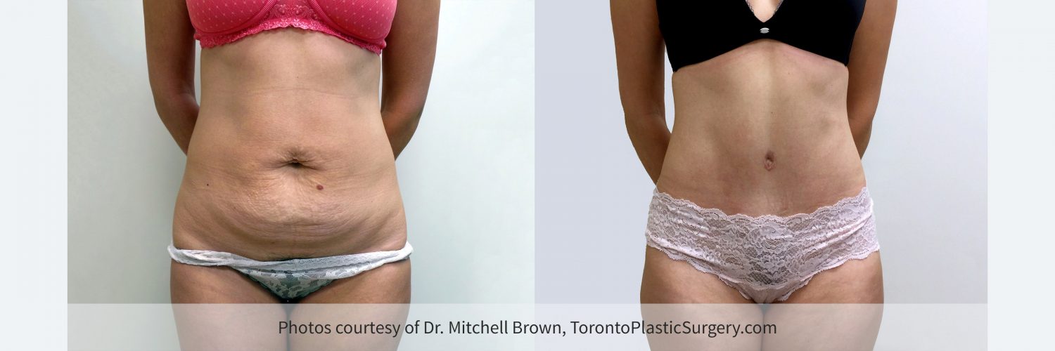 Case 7: Tummy Tuck, Before and 6 Months After