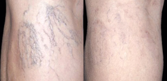 “Spider” veins treated with laser, Before and After