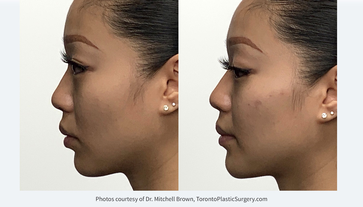 Facial contouring with dermal filler for cheeck definition and chin elongation: Voluma in cheeks, Volux in chin