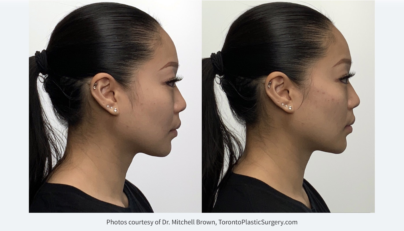 Facial contouring with dermal filler for cheeck definition and chin elongation: Voluma in cheeks, Volux in chin